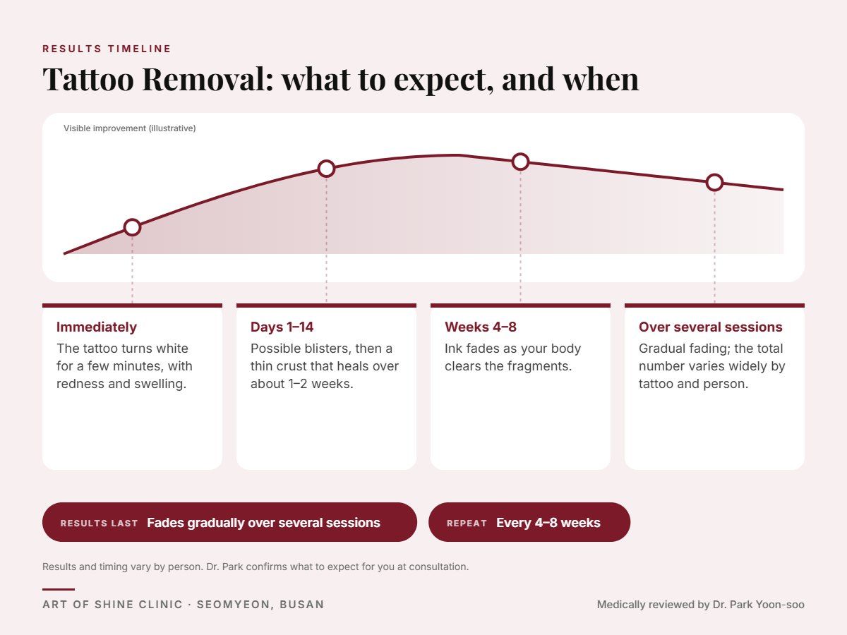 Tattoo Removal results timeline: when results appear and peak, and how long they last (Fades gradually over several sessions)