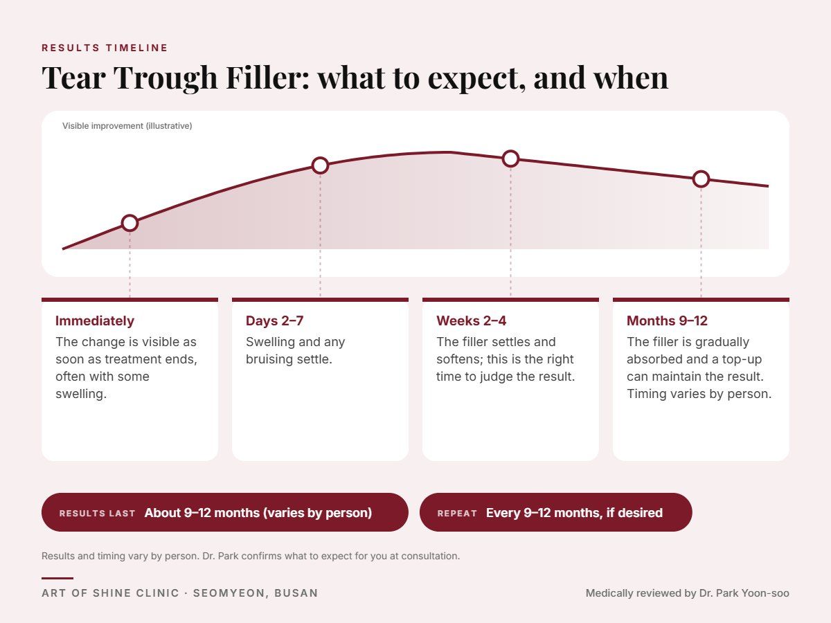 Tear Trough Filler results timeline: when results appear and peak, and how long they last (About 9&ndash;12 months)