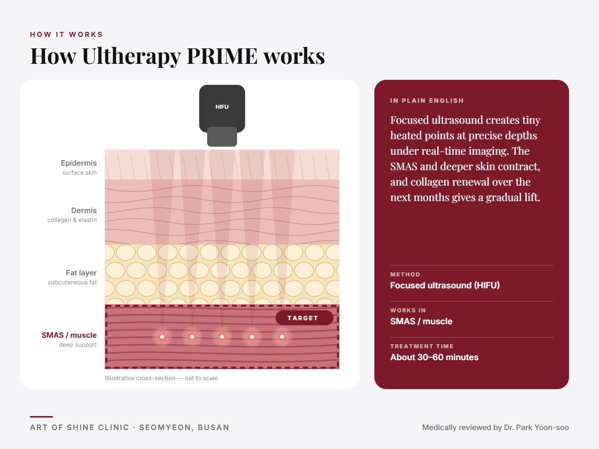 How Ultherapy PRIME works: illustrated skin cross-section showing focused ultrasound (HIFU) reaching the SMAS and muscle layer