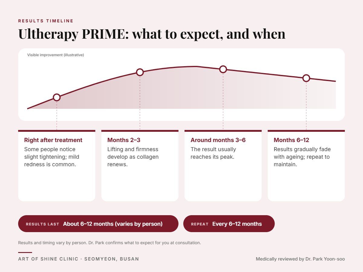 Ultherapy PRIME results timeline: when results appear and peak, and how long they last (About 6&ndash;12 months)