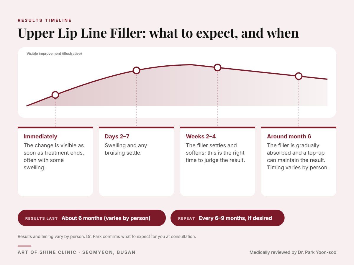 Upper Lip Line Filler results timeline: when results appear and peak, and how long they last (About 6 months)