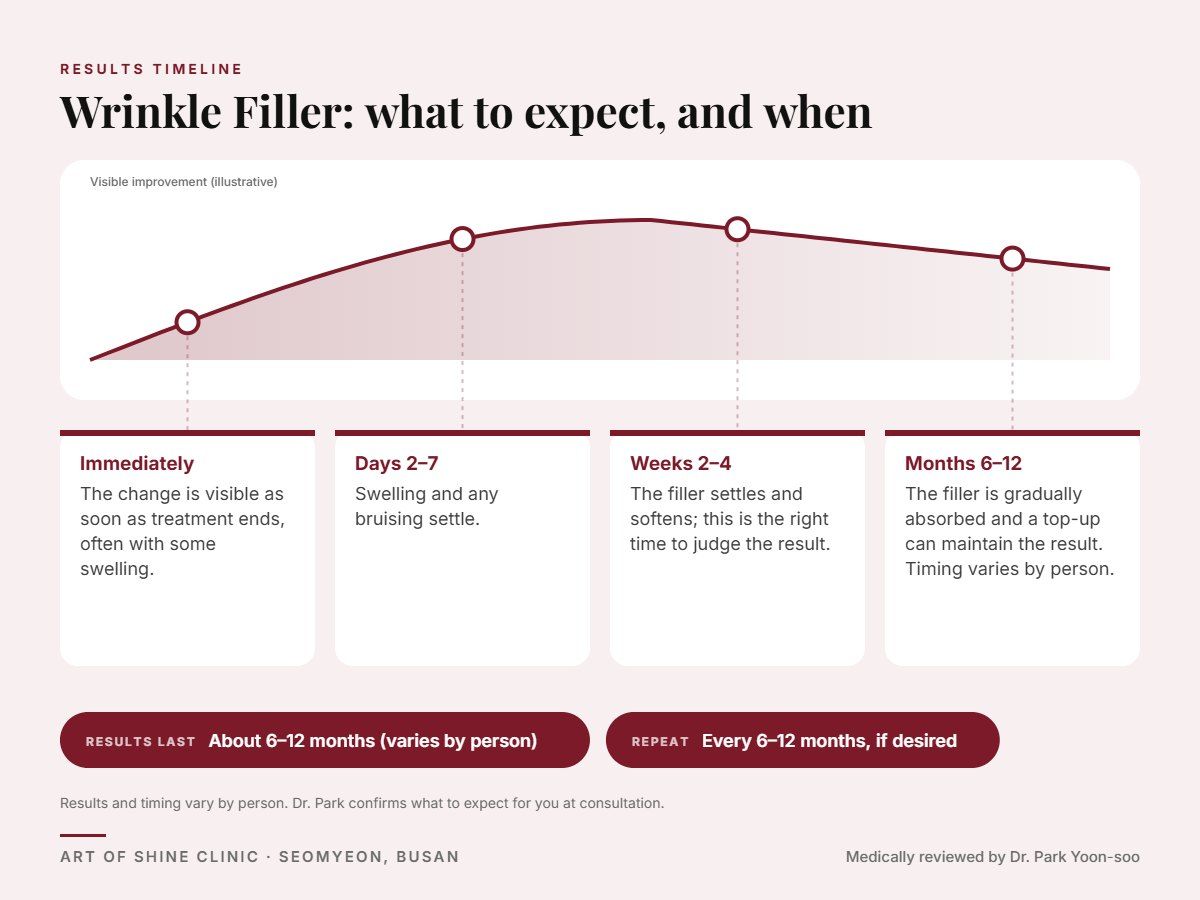 Wrinkle Filler results timeline: when results appear and peak, and how long they last (About 6&ndash;12 months)