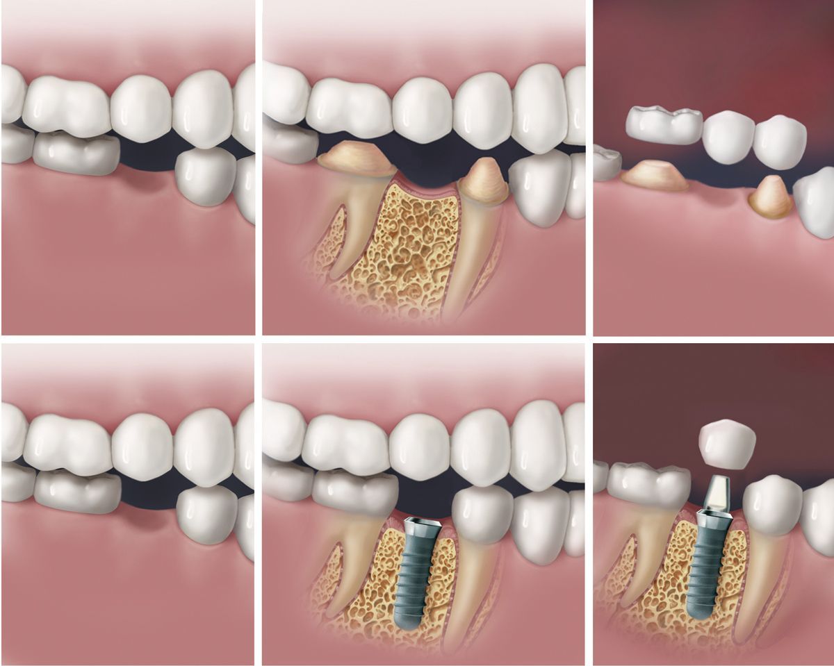 implants vs bridge