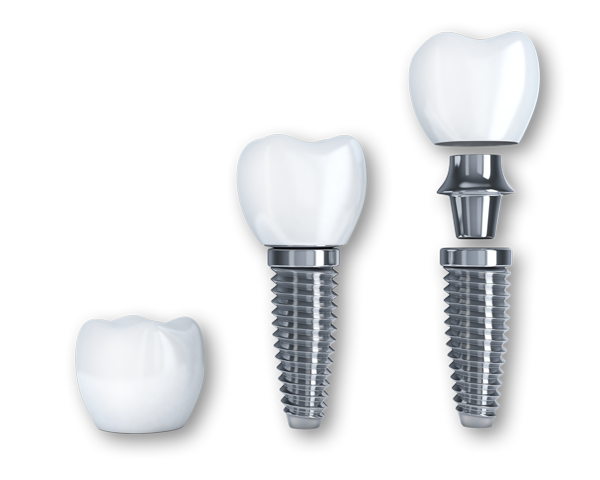 Dental implants