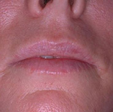Lip Augmentation | Dr Ram Kalus | Charleston, SC