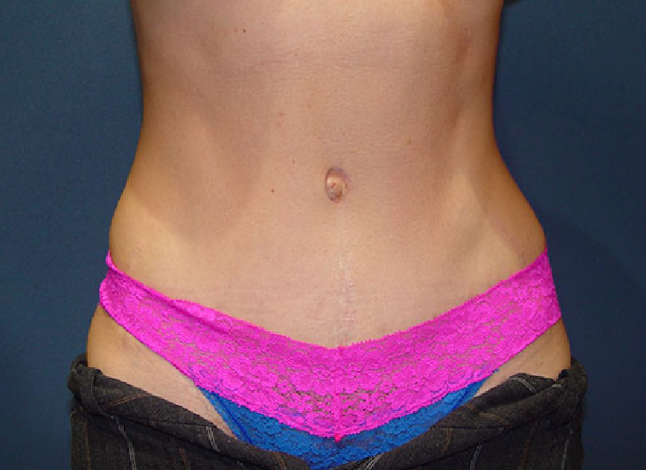abdominoplasty tummy tuck surgery in Charleston