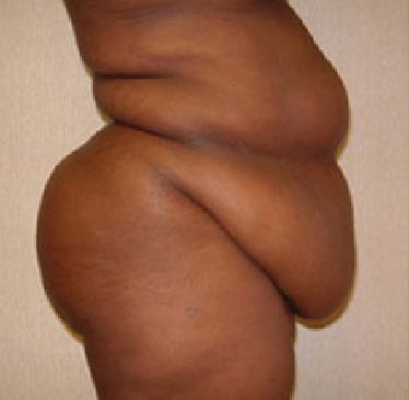 abdominoplasty