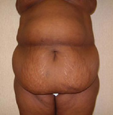 abdominoplasty