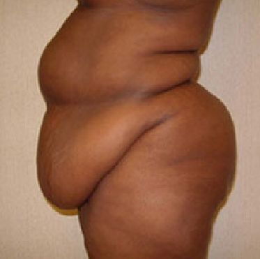 tummy tuck