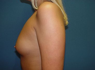 boob job pre op