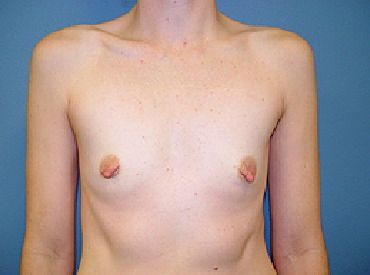 boob job pre surgery