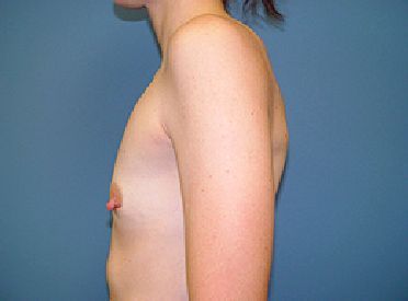 breast reconstruction pre op