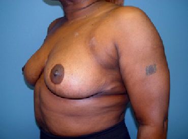 breast reduction surgery charleston