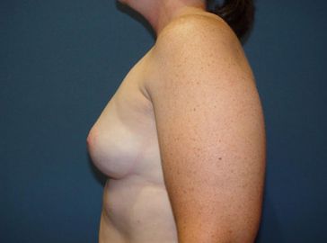 boob job pre op