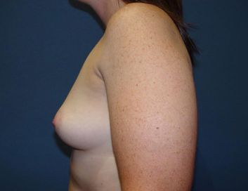 boob job