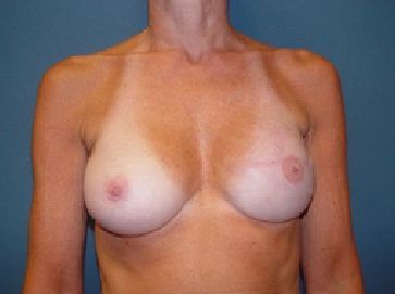 mastopexy