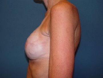 boob job
