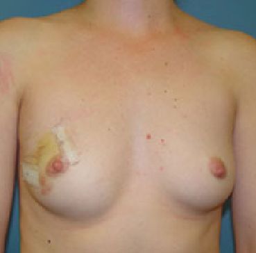 breast 
