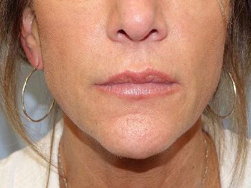 lip filler