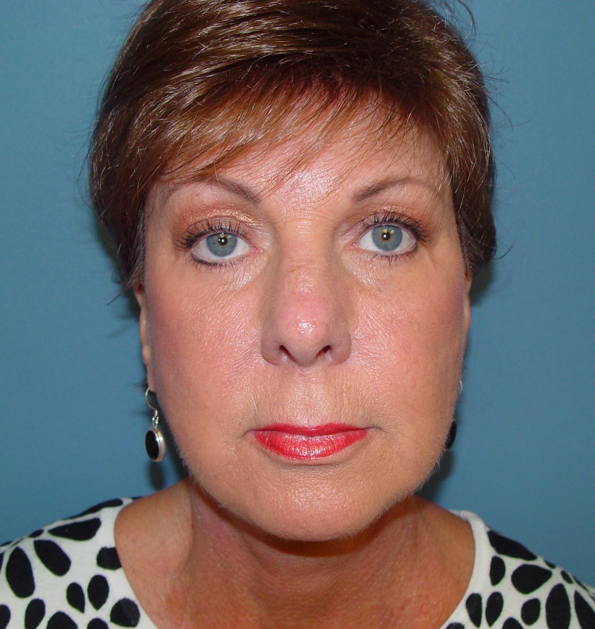 Plastic surgery facelift post-op