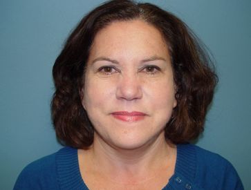 Plastic surgery facelift post-op
