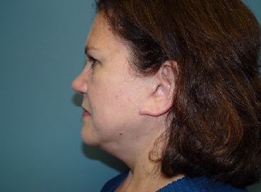 Plastic surgery facelift post-op