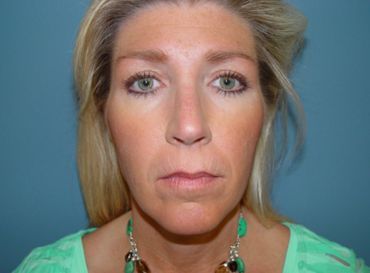Plastic surgery facelift post-op