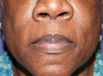 Plastic surgery facelift post-op