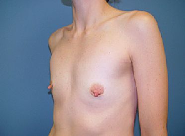 mommy makeover pre op