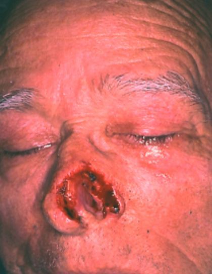 nose job