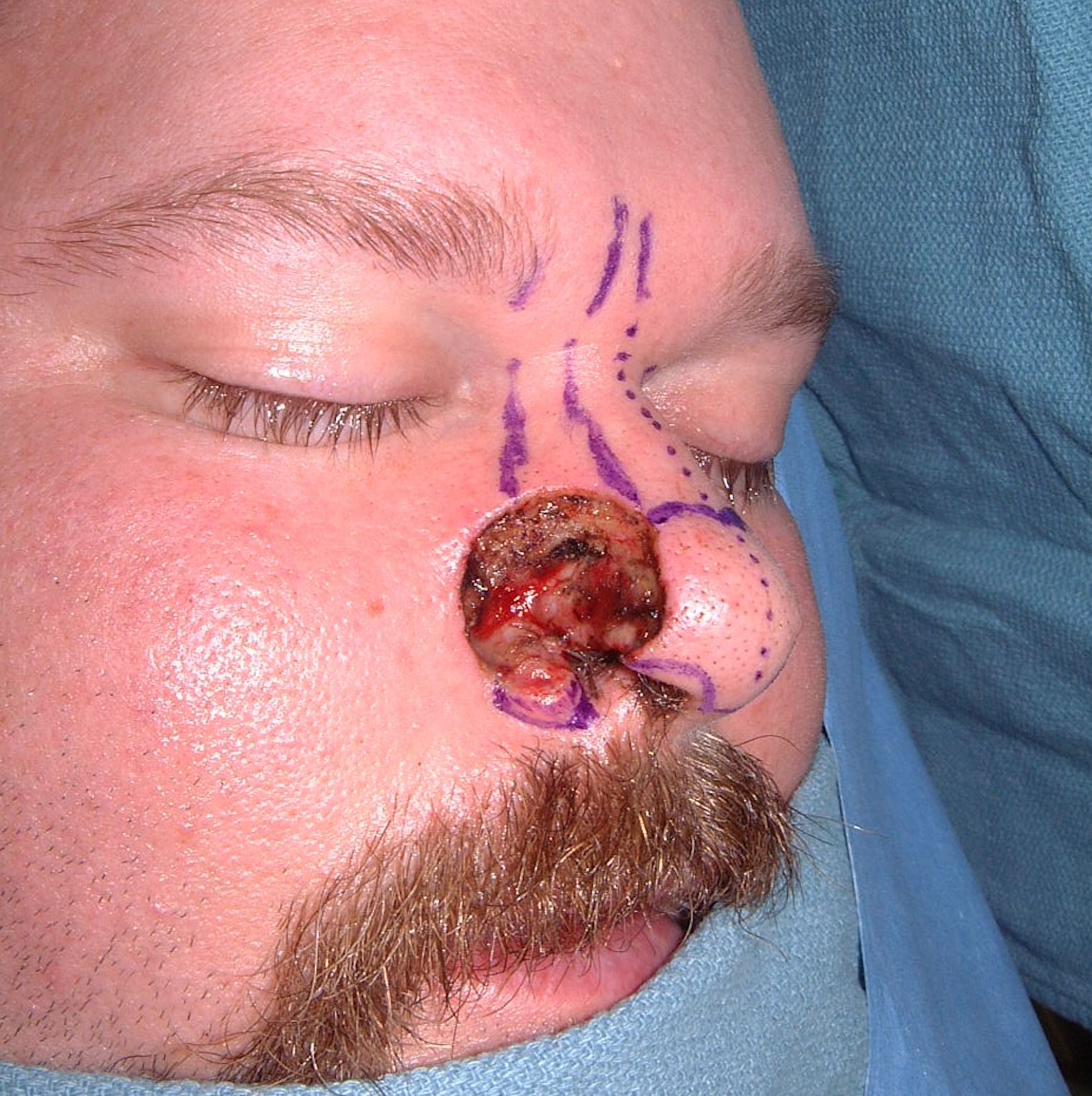 nose job