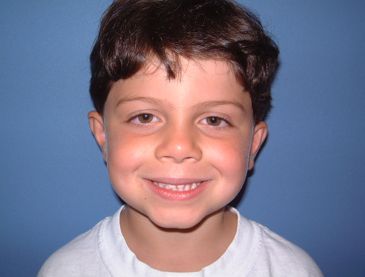 otoplasty post-op