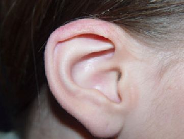 otoplasty post-op