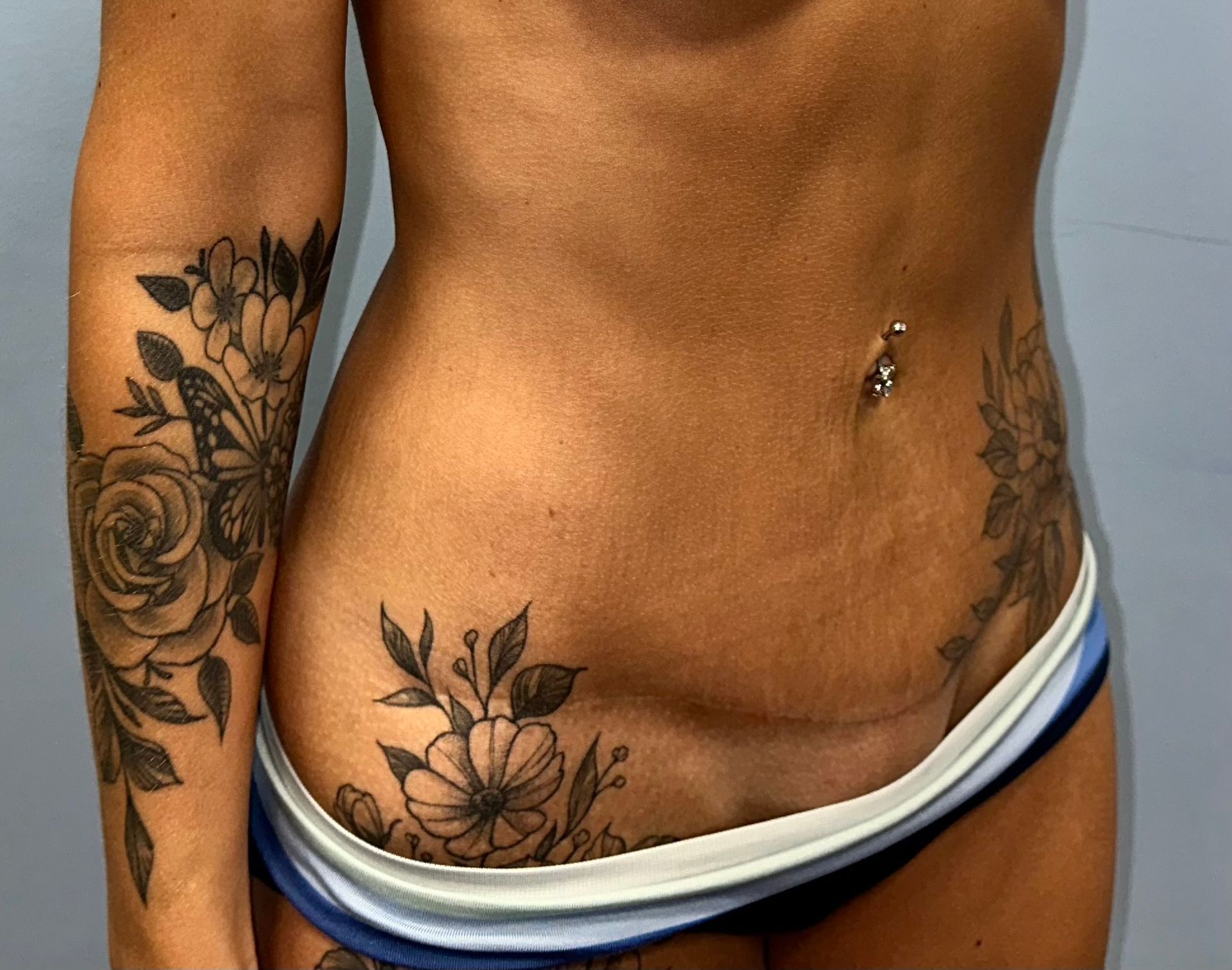 dr kalus mommy makeover charleston post op