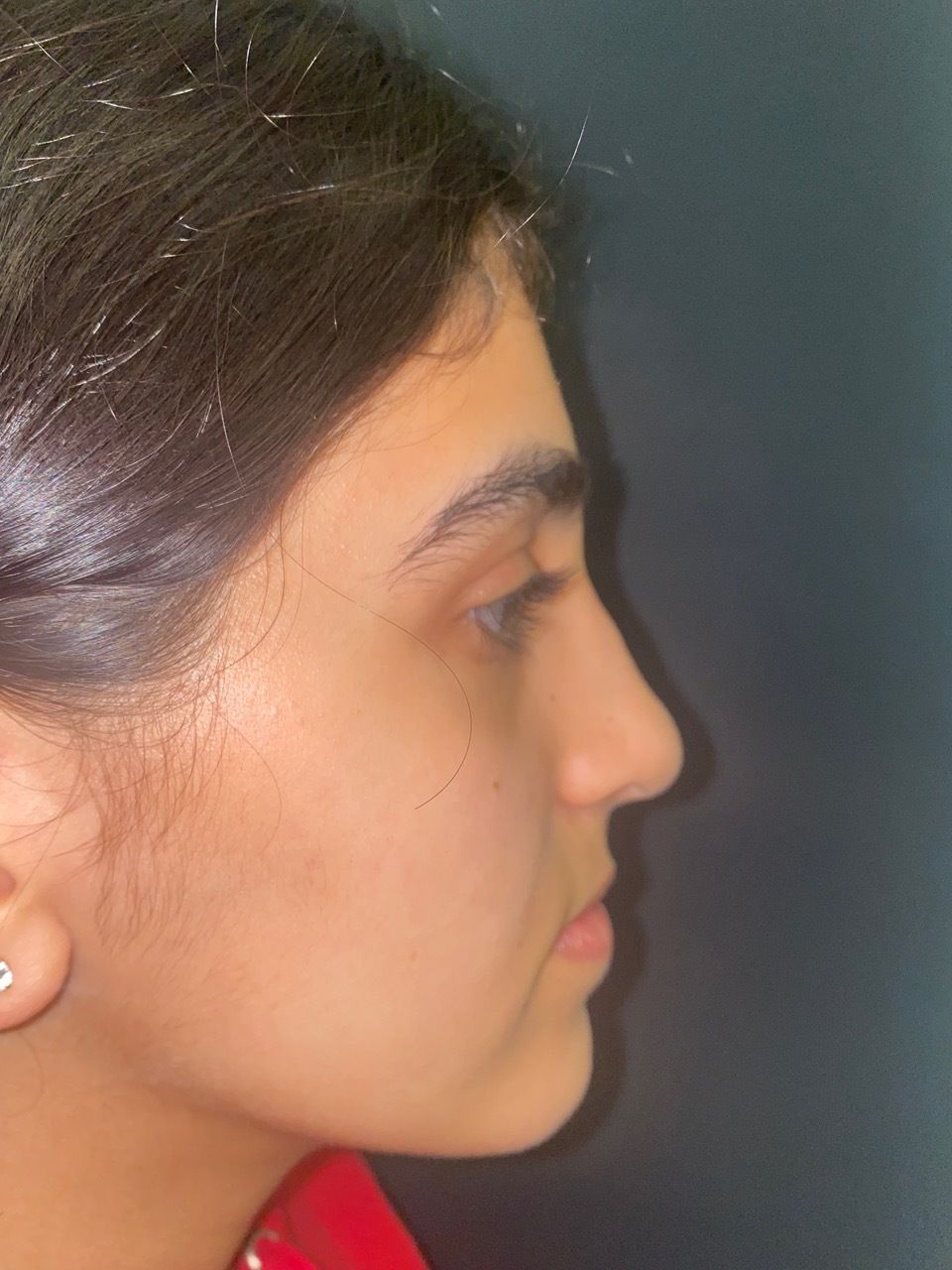 rhinoplasty post op charleston