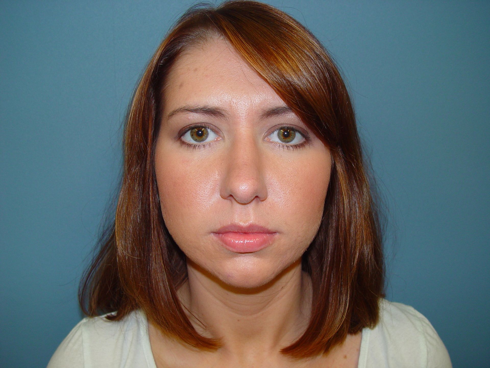 rhinoplasty post op charleston