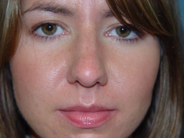 A close up of a woman 's face with a red nose.