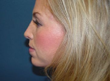 A close up of a woman 's face with red cheeks.