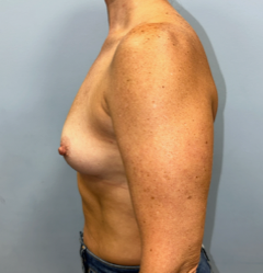 boob job pre op