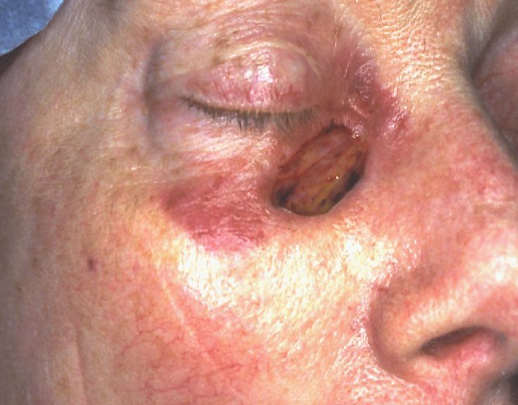 skin cancer