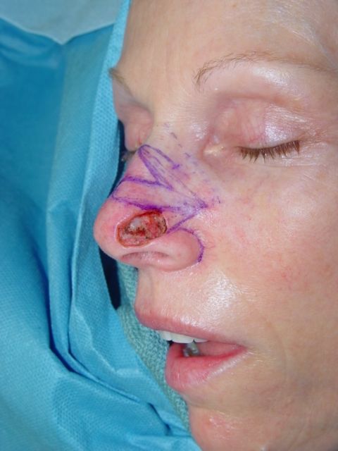 skin cancer