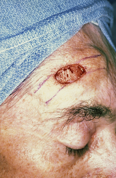 skin cancer