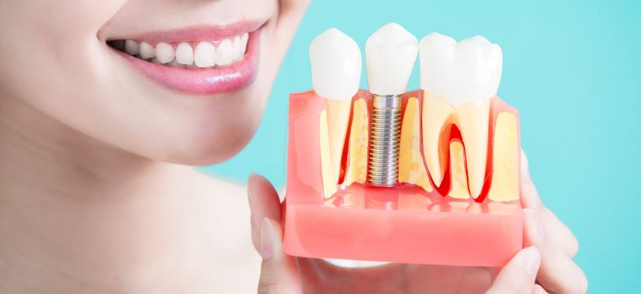 IMPLANTS