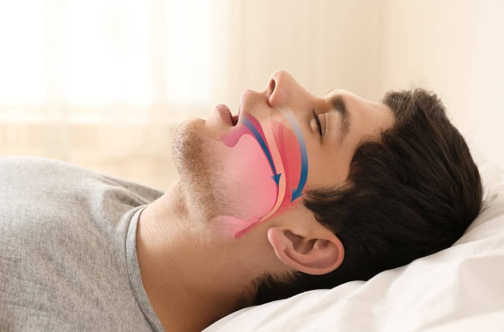 SNORING INTERVENTION