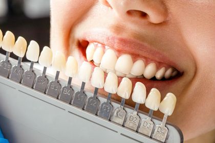 Close-up of smiling mouth beside a tooth shade guide for teeth whitening comparison