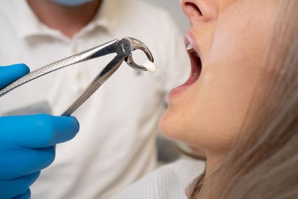 Dentist using blue-gloved forceps to remove a tooth from a patient's open mouth