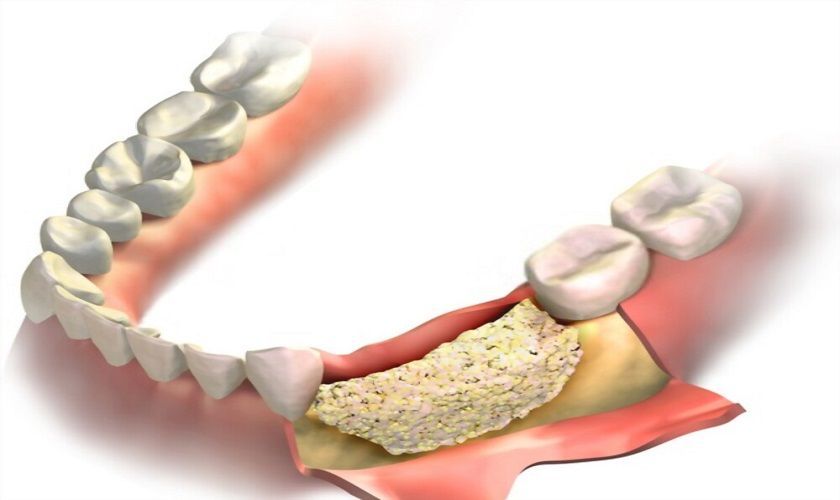 Bone Grafting