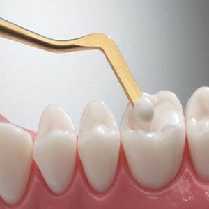 composite-fillings-cosmetic-dentist