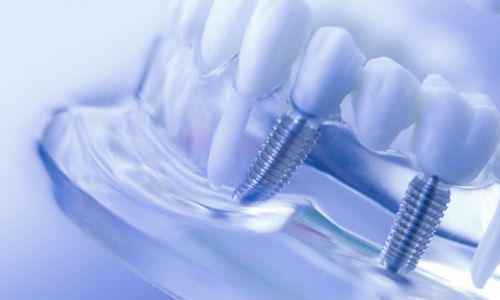 Dental Implant Guide-Lawrenceville, NJ