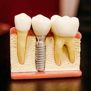 Same-Day-Dental-Implants-Ewing, NJ-Dentist